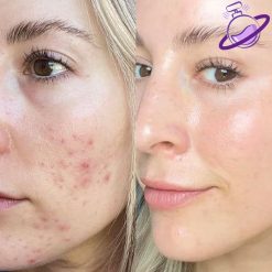 تونر ضد جوش - برند بیوکسین